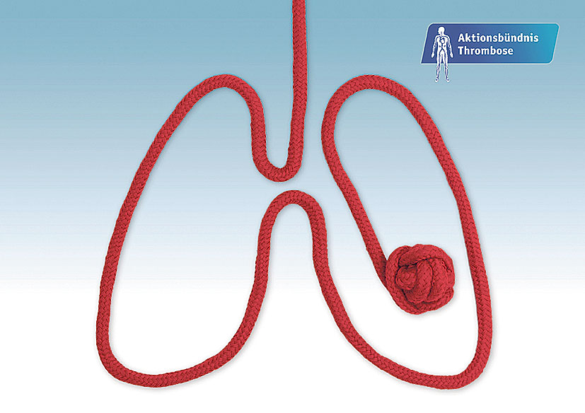 Rotes Seil in Form einer Lunge drapiert; das Ende ist ein Knäuel und symbolisiert ein Blutgerinnsel.