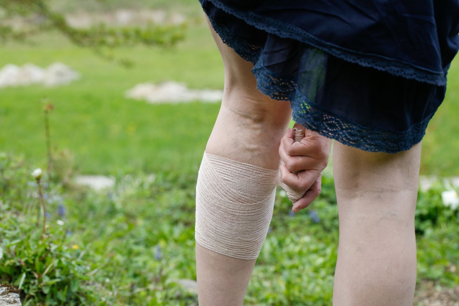 Frau bandagiert ihr Bein mit Krampfadern bzw. Venenthrombose